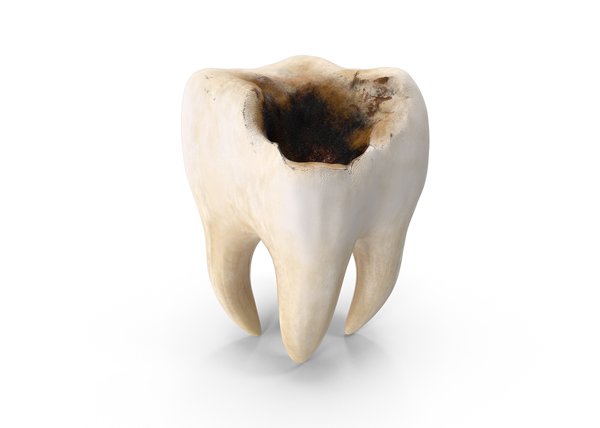 Caries